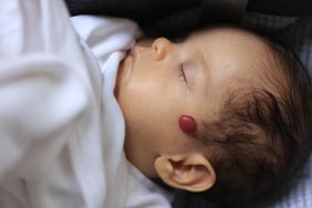A baby with a red growth on its cheek sleeps