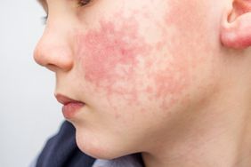 boy with red cheeks due to fifth disease, a result of parvovirus b19