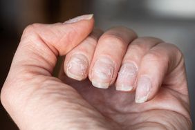 Close up of a hand with peeling, brittle nails. 