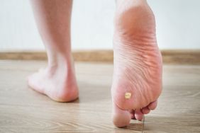 Close up photo of plantar wart on foot