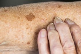 Close-up of older adult's arm with lentigo (liver spots)