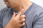 A man points to the skin tags on his neck