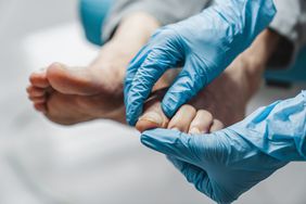 closeup image of doctor wearing blue gloves holding the feet and examining the nails of a person with a fungal infection