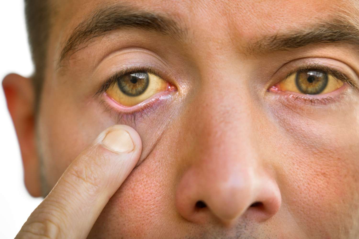 person with jaundice experiencing yellow skin and eyes