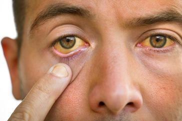 person with jaundice experiencing yellow skin and eyes