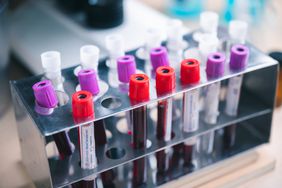 laboratory samples of blood testing