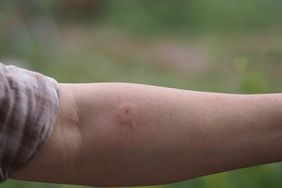 Wasp,hornet stings arm woman red swelling 