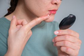 person using topical cream for pimple on the lip