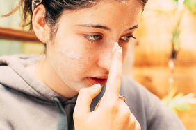 Person applies cream to their face with eczema marks.