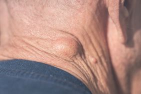 A lipoma, a bump, on the back of a person's neck