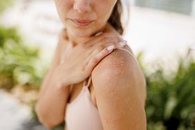 person standing outside experiencing skin peeling on shoulder