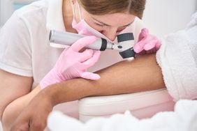 Dermatologist using dermatoscopy to look at hyperkeratosis