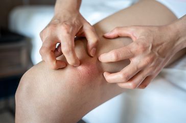 Person itching inner thigh rash