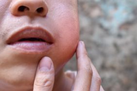 close up image of person with extremely swollen cheeks