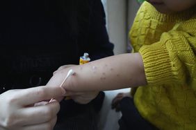 Adult applying ointment to arm of child with chickenpox