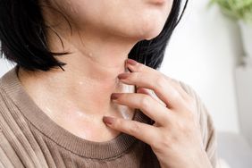 Person itching rash on neck