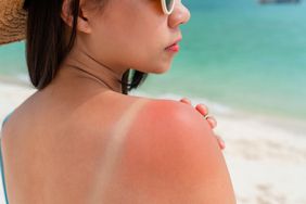 A woman on a beach has sunburn on her shoulder
