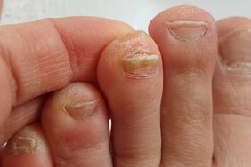 a foot with a thickened toenail