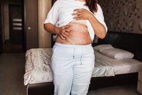 person experiencing red bumps on the skin