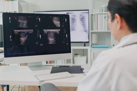 Doctor looks at chest x-ray to look at a person's lungs.