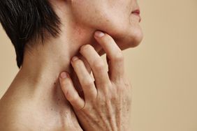 Close up of person scratching their neck where a small rash is.