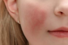 Redness on child's cheeks caused by fifth disease, which is sometimes called slapped cheek disease