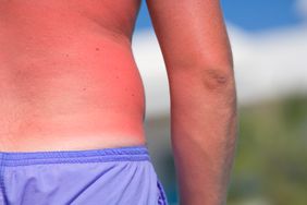 Sunburn