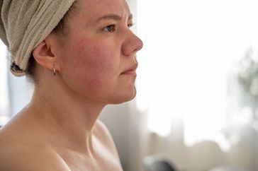 A woman with flushed skin on her face