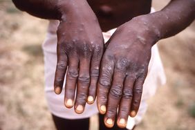 The back of the hands of a patient with mpox