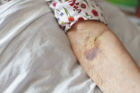 solar purpura bruise on the forearm of an older person 