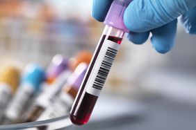 Scientist holding a blood sample with medical samples in a tray awaiting clinical testing in a laboratory.