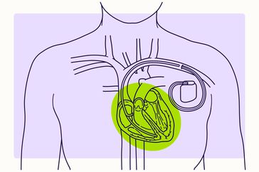 Overview Illustration - Heart Failure