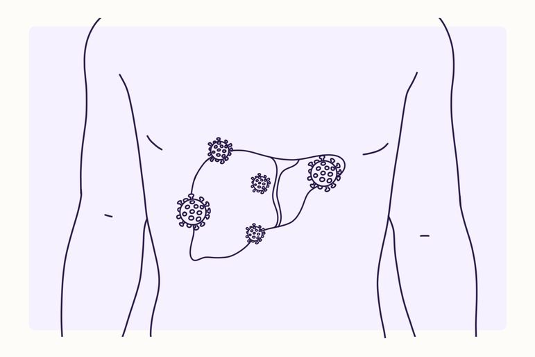 Overview Illustration - Hepatitis C