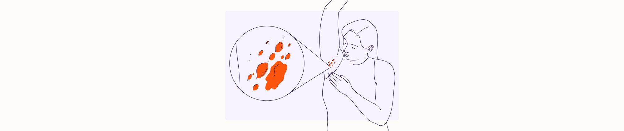 Health condition Illustration - Hidradenitis Suppurativa