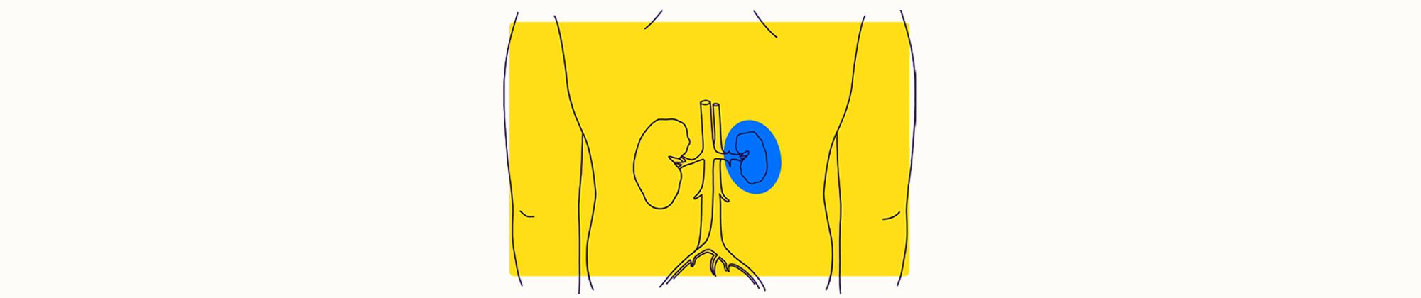 Overview Illustration - Kidney Failure