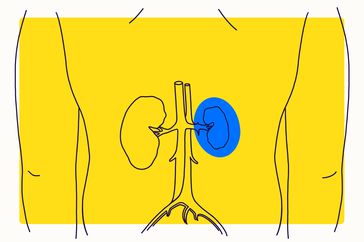 Overview Illustration - Kidney Failure