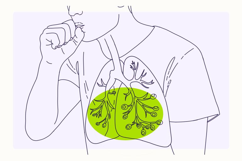 Illustration overview for lung cancer