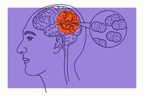 Health Overview Illustration - Meningitis