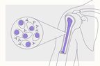 Health Overview Illustration - Multiple Myeloma