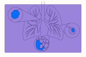 Health Overview Illustration - Non-Small Cell Lung Cancer