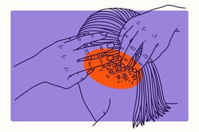 Illustration of Psoriasis