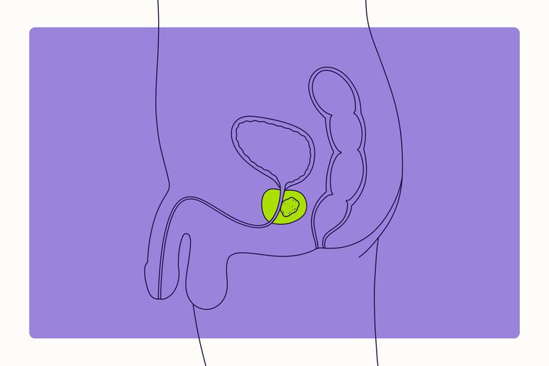 Health Overview Illustration - Prostate Cancer
