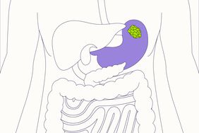 Stomach Cancer Repository Illustration