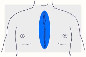 Overview Illustration - Heart Disease