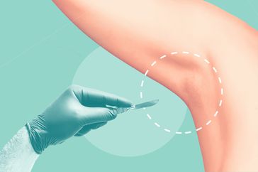 hyperhidroisis surgery