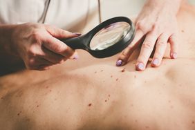 matologist examining moles on the back of a patient