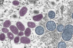 Digitally-colorized electron microscopic (EM) image depicting a monkeypox virion (virus particle), obtained from a clinical sample associated with a 2003 prairie dog outbreak, published June 6, 2022. The image depicts a thin section image from a human skin sample. On the left are mature, oval-shaped virus particles, and on the right are the crescents and spherical particles of immature virions. Courtesy CDC/Goldsmith at al. (Photo via Smith Collection/Gado/Getty Images)