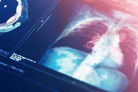 Multifocal-Pneumonia-GettyImages-1299730658