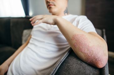 a man with plaque psoriasis