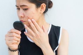 person examining facial acne that has pus